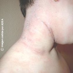 Descubren un nuevo tipo de célula inmune que combate trastornos de la piel como la psoriasis
