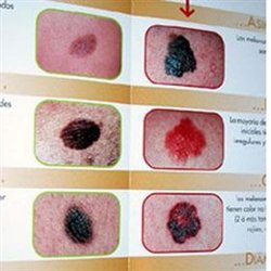 Identifican una tercera zona del genoma humano relacionado con el cáncer de piel