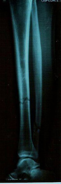 Abren la vía al desarrollo de una nueva clase de fármacos para la osteoporosis