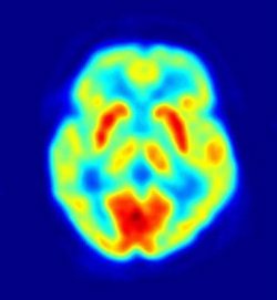 Daños selectivos en el cerebro modulan la espiritualidad
