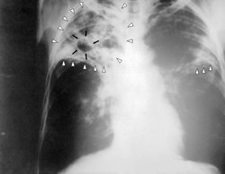 Un test diagnostica la tuberculosis en sólo dos horas