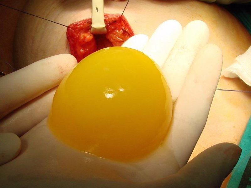 El aumento del pecho por las pastillas contraceptivas las revocaciones