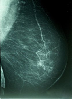 El cáncer de mama causa más muertes entre las mujeres más mayores