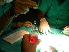 Transplante De Córneas