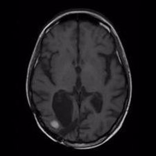Resonancia Magnética De Un Cerebro Con Metástasis