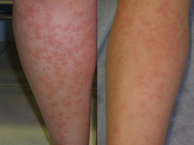 La psoriasis sobre la cabeza de la causa y los síntomas