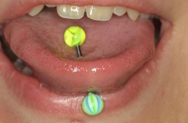 Foto: El 70% de las personas con 'piercings' en la boca pueden tener problemas de salud bucodentales (PLÉNIDO QUALITY DENTAL GROUP)