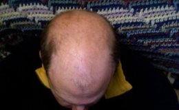 Foto: Las vitaminas y champús cosméticos para la alopecia no tienen "ninguna" efectividad médica y no frenan la caída del pelo (SMOBSERVER / EN.WIKIPEDIA)