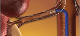 Foto: Un tercio de hipertensos dejaría de serlo gracias a la denervación renal (EUROPA PRESS)