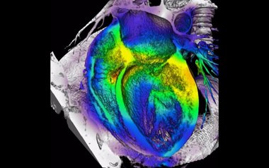 Foto: Asocian medicamentos contra el Alzheimer con menor riesgo de infarto (ASOCIACIÓN ESPAÑOLA DE IMAGEN CARDÍACA )