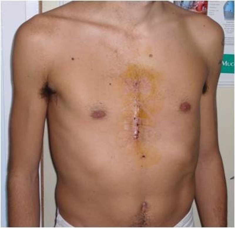 HOSPITAL BELLVITGE TORACICA hospital bellvitge toracica: