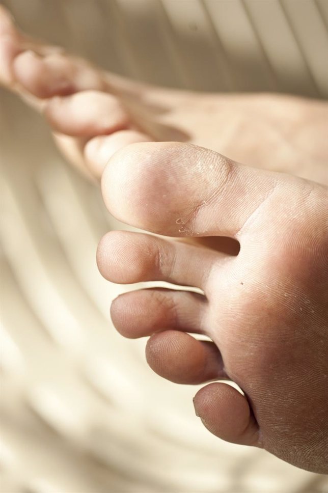 El hongo sobre el pulgar del pie en la piel