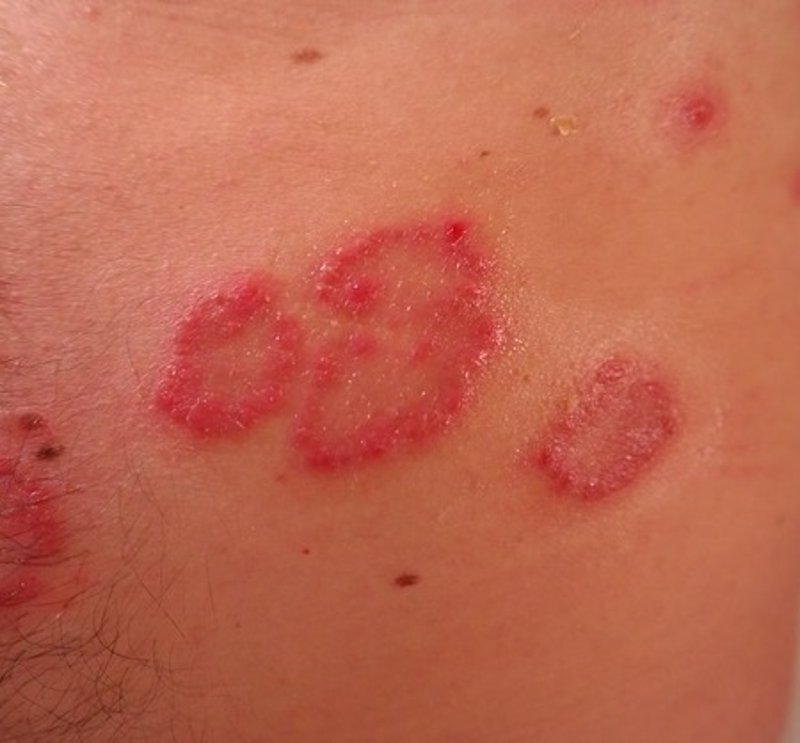 Que curar las cortezas a atopicheskom la dermatitis