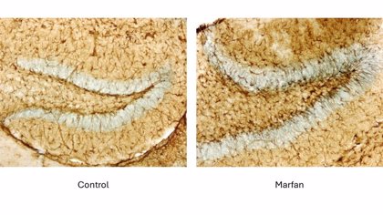 El síndrome de Marfan aumenta el riesgo de sufrir alteraciones cerebrales, según un estudio