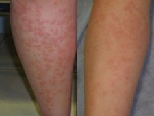 Home Care for Hives (Urticaria)