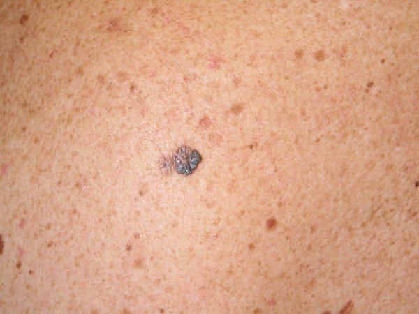Más del 80% de los casos de cáncer de piel se podrían prevenir evitando una exposición excesiva al sol