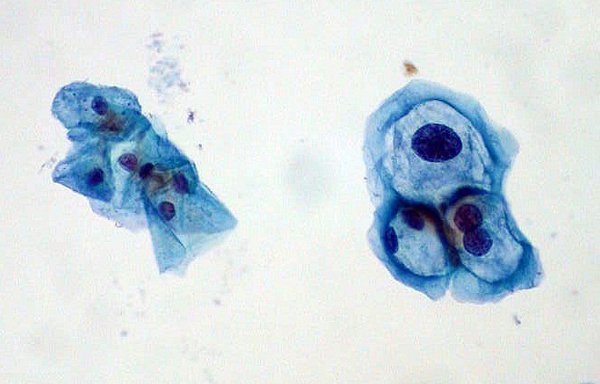 Cuando el cáncer de orofaringe se asocia al virus del papiloma pueden utilizarse terapias menos agresivas