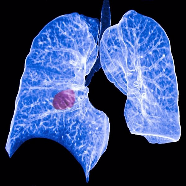 El Grupo Español de Cáncer de Pulmón solicita más apoyo e inversión para la investigación en cáncer de pulmón