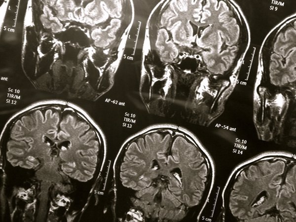 Detectan infecciones causadas por hongos en cerebros de pacientes fallecidos con Alzheimer