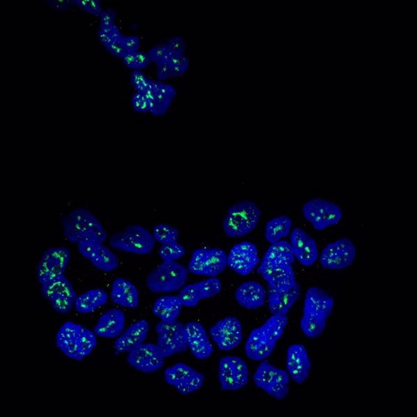 Identifican una proteína que mantiene dormidas las células en metástasis del cáncer de mama