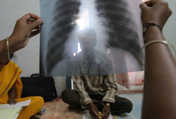 Hasta 1,7 millones de personas mueren al año por tuberculosis, según MSF