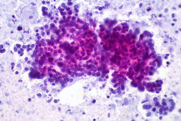 Un estudio confirma que la quimioterapia de platino mejora la supervivencia en pacientes con cáncer de páncreas