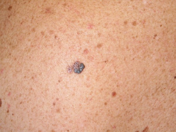Alrededor del 45% del los pacientes que son diagnosticados de melanoma son portadores de una mutación BRAF