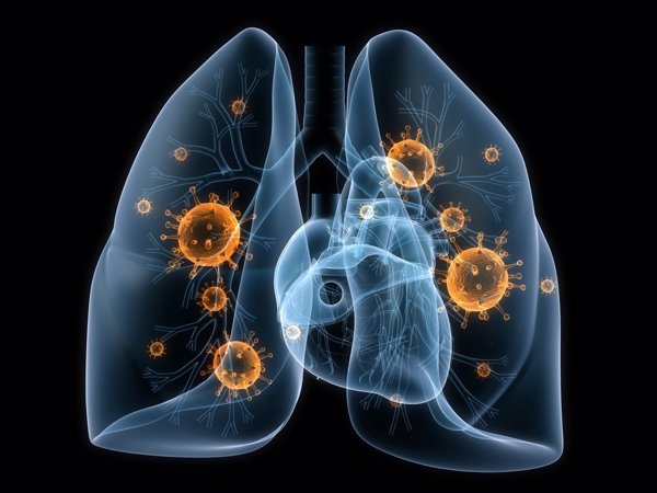 Los pacientes con cáncer de pulmón esperan 10 días para iniciar el tratamiento en la sanidad privada, según un estudio
