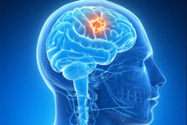 La inmunoterapia puede ser eficaz en un tumor cerebral que padecen pacientes con neurofibromatosis tipo 1