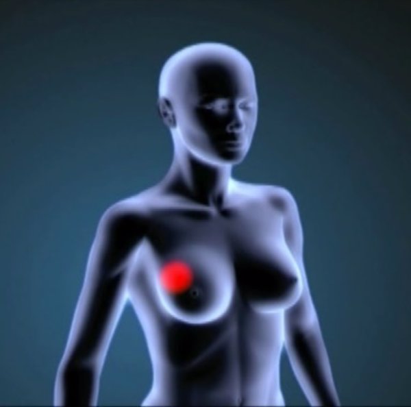 Hallan que una proteína podría jugar un papel en la prevención del crecimiento y diseminación del cáncer de mama