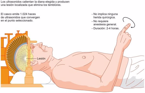 Clínica Universidad de Navarra incorpora ultrasonidos para tratar sin cirugía el temblor del Parkinson