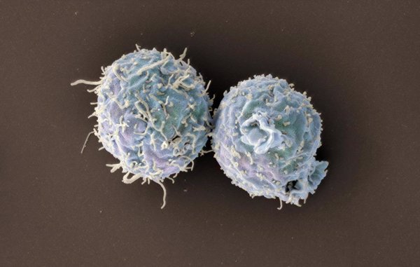 Científicos consiguen crear una fuente renovable de células T que combate el cáncer