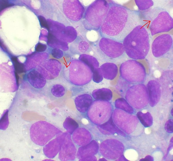 Investigadores desarrollan una nueva posible terapia contra la leucemia mieloide aguda