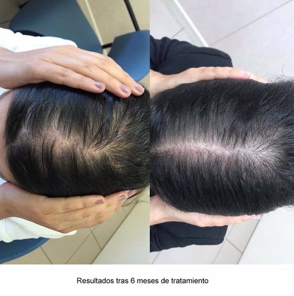 La consulta de tricología de H. Quirónsalud San José aplica una nueva terapia para la alopecia androgenética