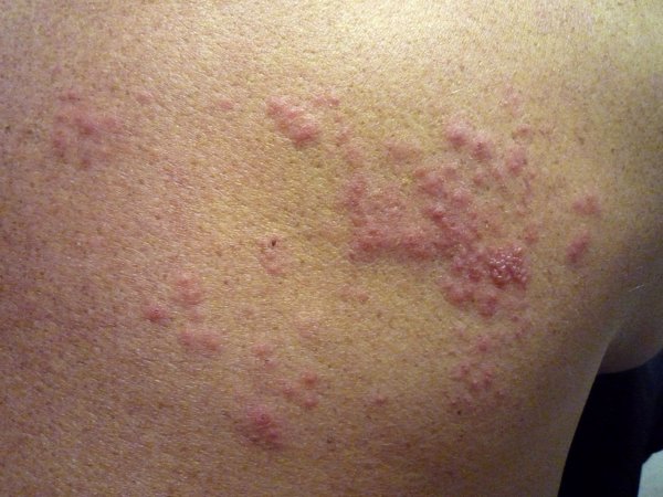 La vacuna contra la varicela reduce el riesgo de herpes zóster en niños, según un estudio