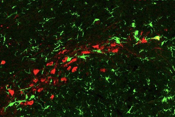 Las neuronas afectadas por el Parkinson no 'mueren' completamente e 'infectan' a otras sanas, según un estudio