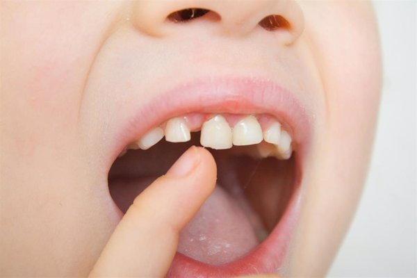 Ocho de cada 10 dientes desprendidos por un traumatismo pueden reimplantarse si se actúa bien, aseguran los odontólogos