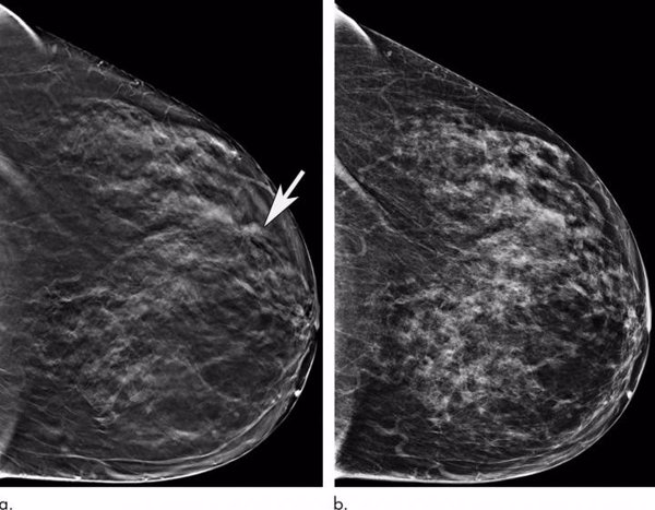 La mamografía 3D mejora la detección precoz del cáncer de mama, según expertos