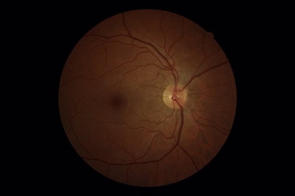 Una experta alerta de la falta de percepción de los síntomas en pacientes con degeneración macular asociada a la edad
