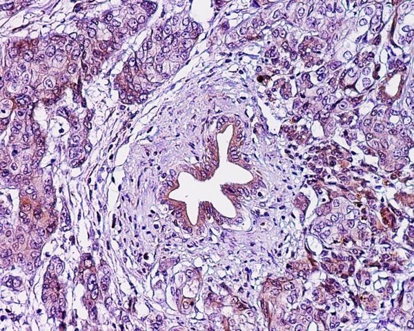 Investigadores de EEUU hallan los mecanismos que ayudan a las células cancerosas pancreáticas a evitar la inanición