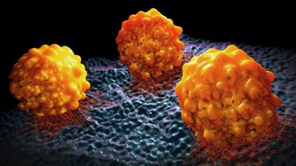 Investigadores sugieren que la metástasis podría prevenirse evitando que las células cancerosas produzcan lípidos