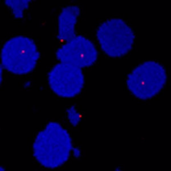 Investigadores encuentran un fármaco con potencial contra el carcinoma de células renales de células claras