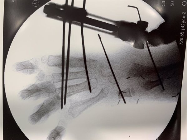 El Hospital HM Nens trata una malformación en la mano de un menor con una técnica pionera