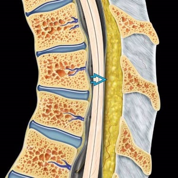 La mayoría de las lipomatosis espinal son producidas por los corticoides, obesidad severa y por problemas hormonales