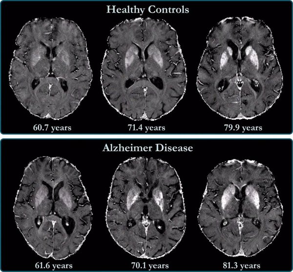 La proximidad a la edad parental de inicio del Alzheimer indica mayor riesgo de enfermedad en mujeres, según un estudio