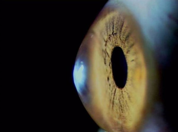 Estudiar el fondo de ojo puede prevenir la aparición de eventos arteriales en infectados, según estudio