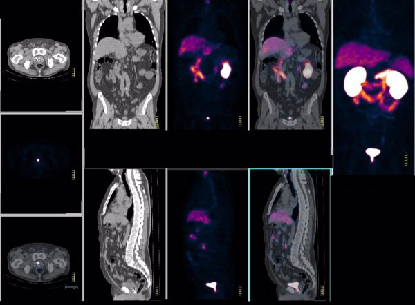 Experta asegura que el PET-TAC con PSMA es una terapia efectiva en la detección y manejo del cáncer de próstata
