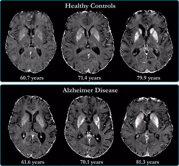 Investigadores españoles descubren una nueva alteración en el cerebro de las personas con Alzheimer