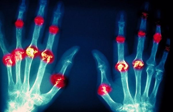 El diagnóstico la artritis reumatoide es clave para un tratamiento adecuado y minimizar las posibles secuelas