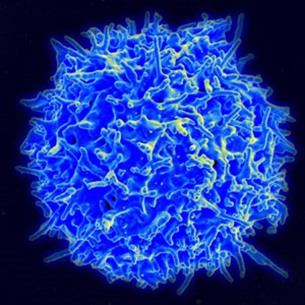 La densidad de los linfocitos T podrían ser clave para predecir la evolución de cáncer de pulmón operable, según estudio